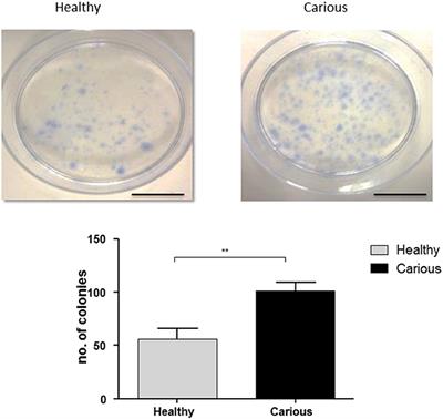 Dental Pulp Cells Isolated from Teeth with Superficial Caries Retain an Inflammatory Phenotype and Display an Enhanced Matrix Mineralization Potential